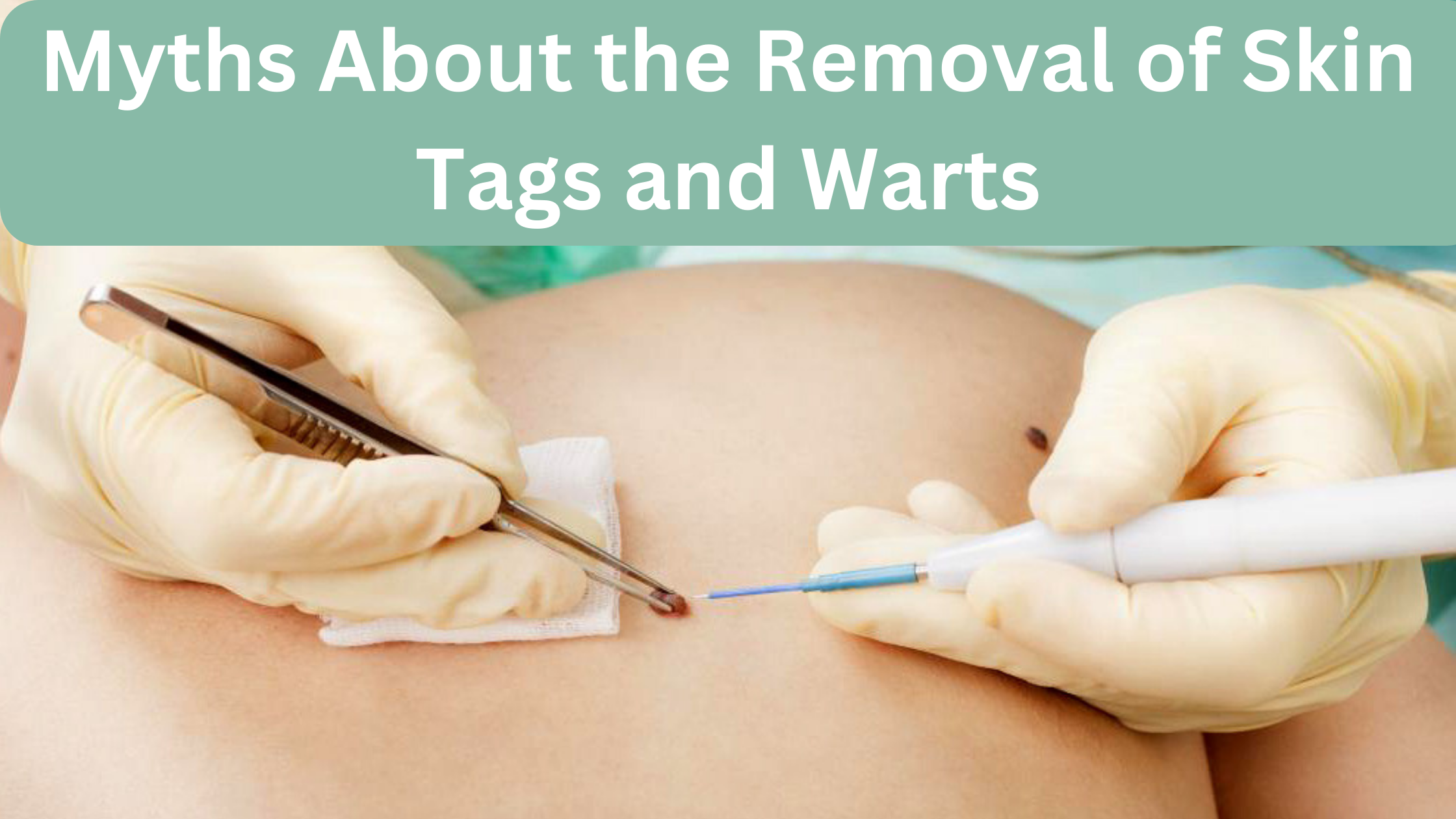 skin tag and wart removal