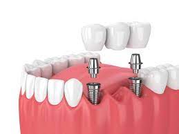 all on four dental implants near me in Sunny Isles Beach, FL